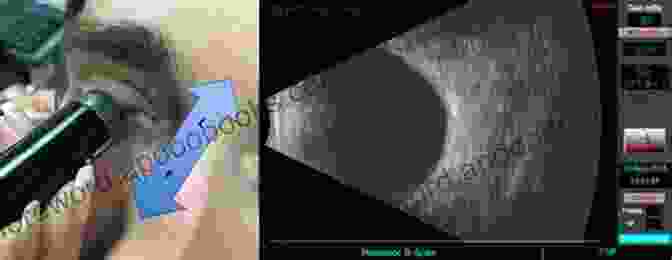 A Highly Detailed Ultrasound Image Of The Eye, Showcasing The Intricate Structures Within. Clinical Atlas Of Ophthalmic Ultrasound