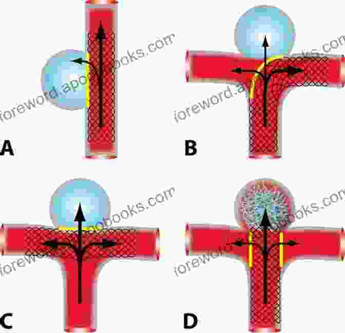 Diagram Of Flow Diversion Of Cerebral Aneurysm Flow Diversion Of Cerebral Aneurysms