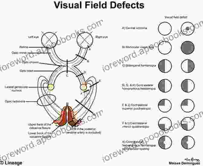 Diagram Of Visual Field Defects, Highlighting Different Scotoma Types. Resolving Dilemmas In Perimetry: Illustrated Manual Of Visual Field Defects