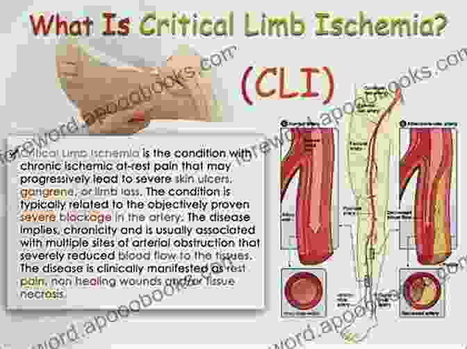 Endovascular Intervention For Critical Limb Ischemia Critical Limb Ischemia Marten Julian