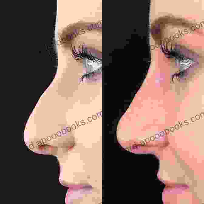 Non Surgical Rhinoplasty Before And After Facial Skin: Contemporary Topics For The Surgeon An Issue Of Facial Plastic Surgery Clinics: Number 1 (The Clinics: Surgery 21)