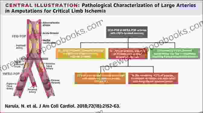 Pathophysiology Of Critical Limb Ischemia Critical Limb Ischemia Marten Julian