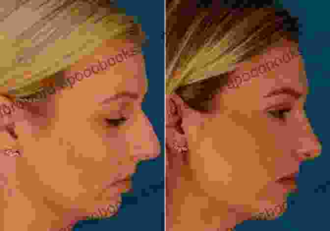 Rhinoplasty Before And After Facial Skin: Contemporary Topics For The Surgeon An Issue Of Facial Plastic Surgery Clinics: Number 1 (The Clinics: Surgery 21)