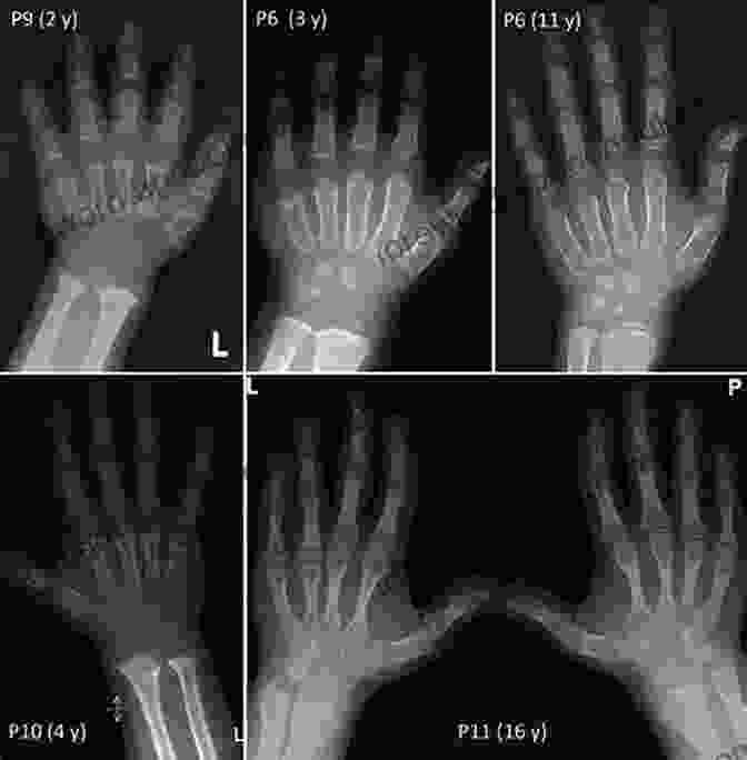 X Ray Image Of A Hand For Age Estimation Age Estimation: A Multidisciplinary Approach